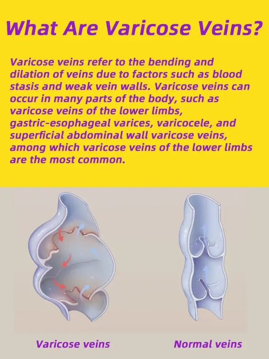 Varicose and Spider Vein Cream - Cindorium